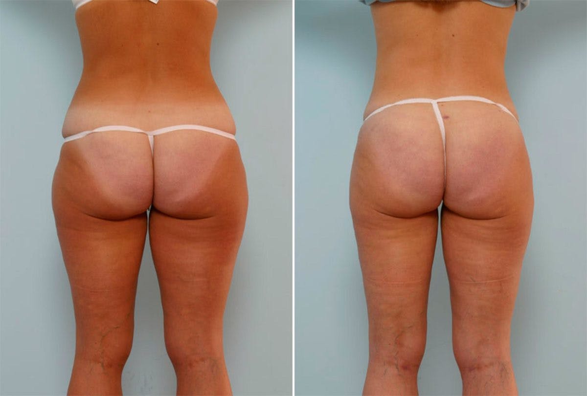 Female Liposuction Before & After Gallery - Patient 54871950 - Image 2