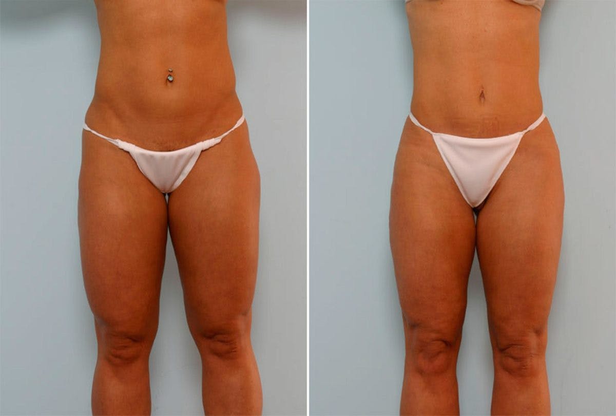 Female Liposuction Before & After Gallery - Patient 54871952 - Image 1