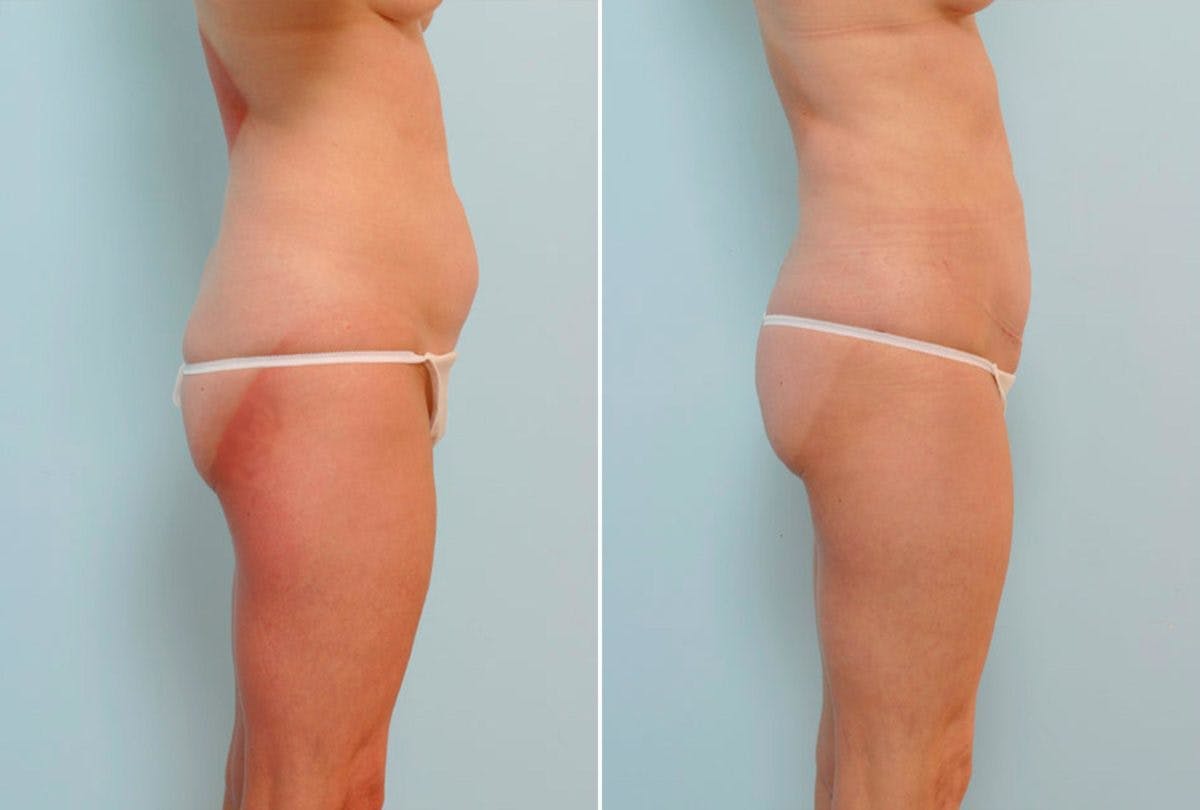 Abdominoplasty Before & After Gallery - Patient 54871951 - Image 3
