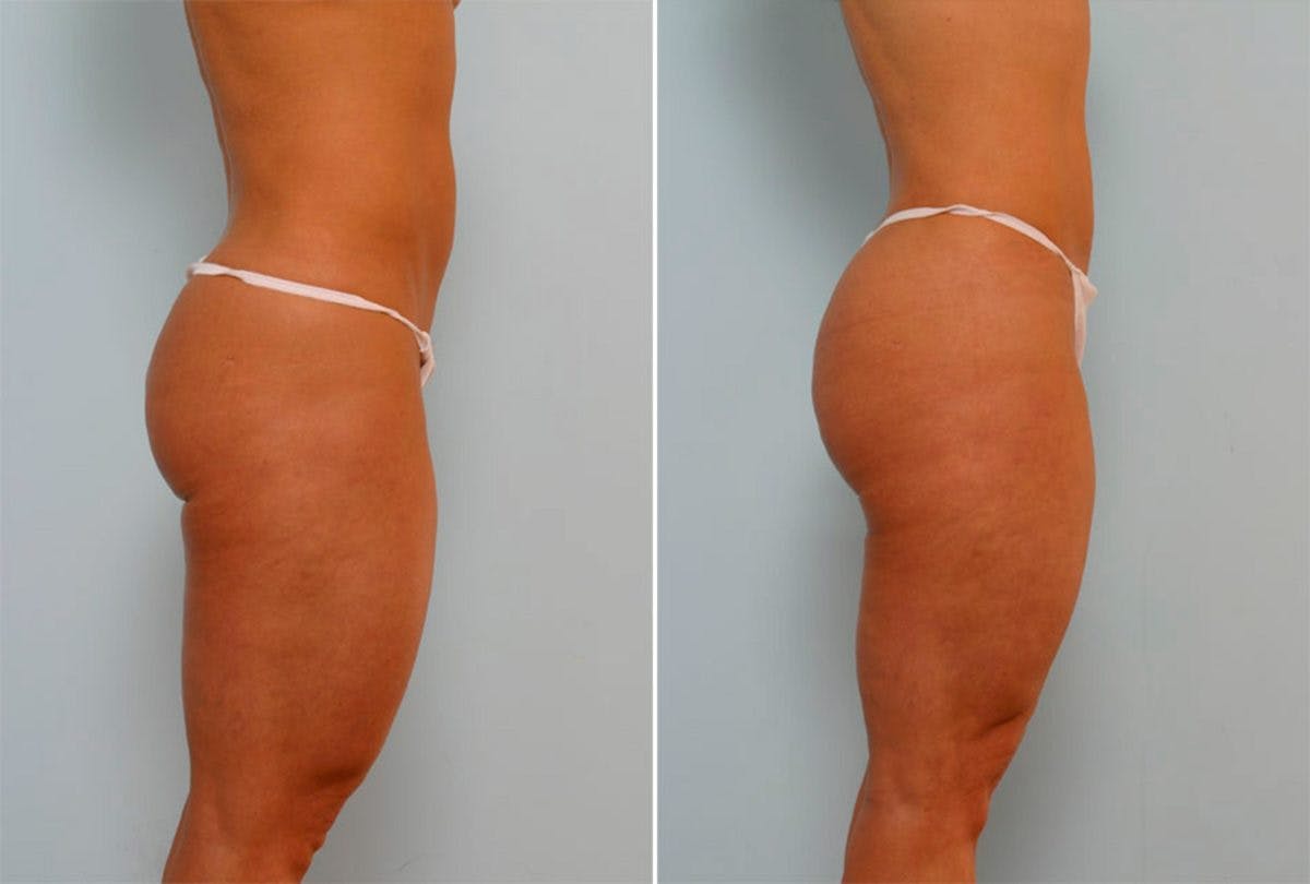 Female Liposuction Before & After Gallery - Patient 54871952 - Image 2