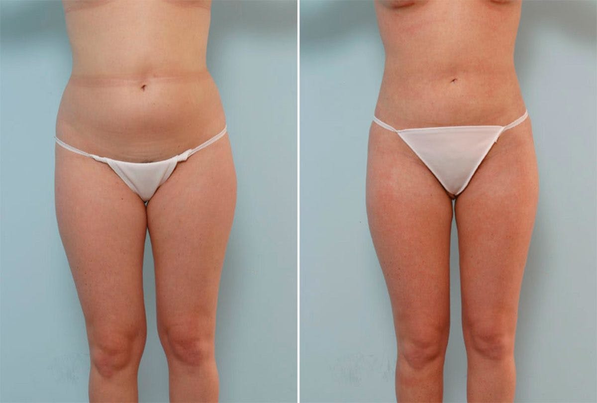 Female Liposuction Before & After Gallery - Patient 54871953 - Image 1