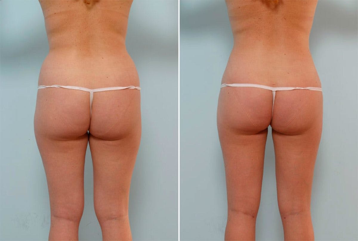Female Liposuction Before & After Gallery - Patient 54871953 - Image 3