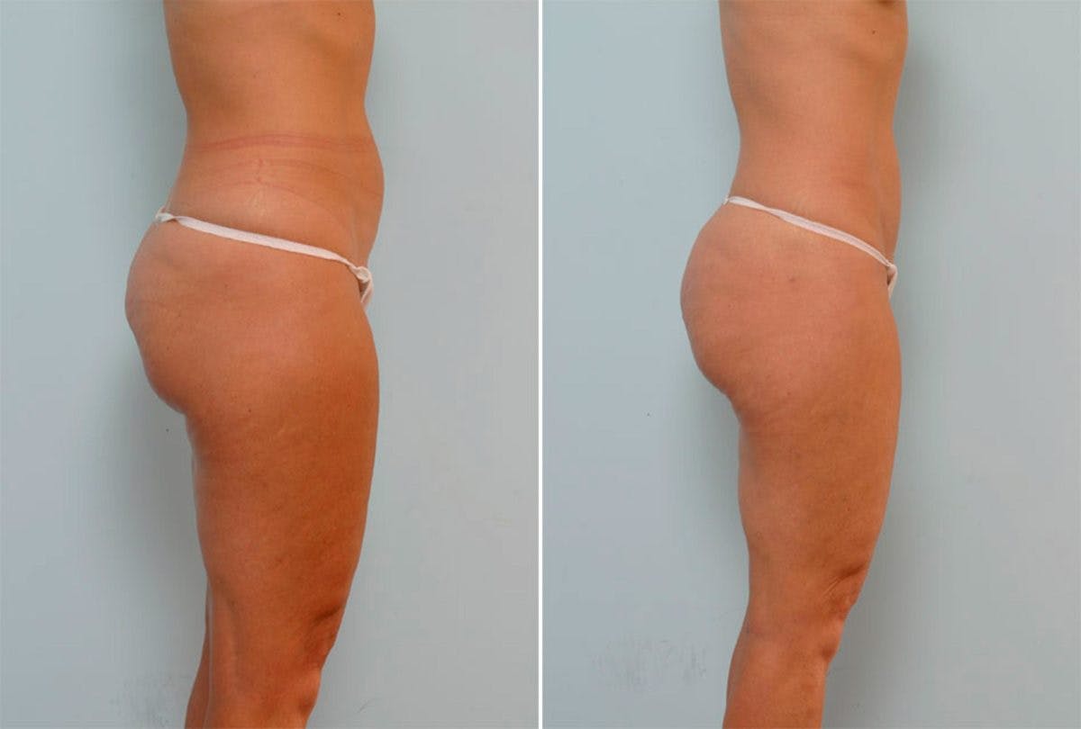 Female Liposuction Before & After Gallery - Patient 54871958 - Image 2