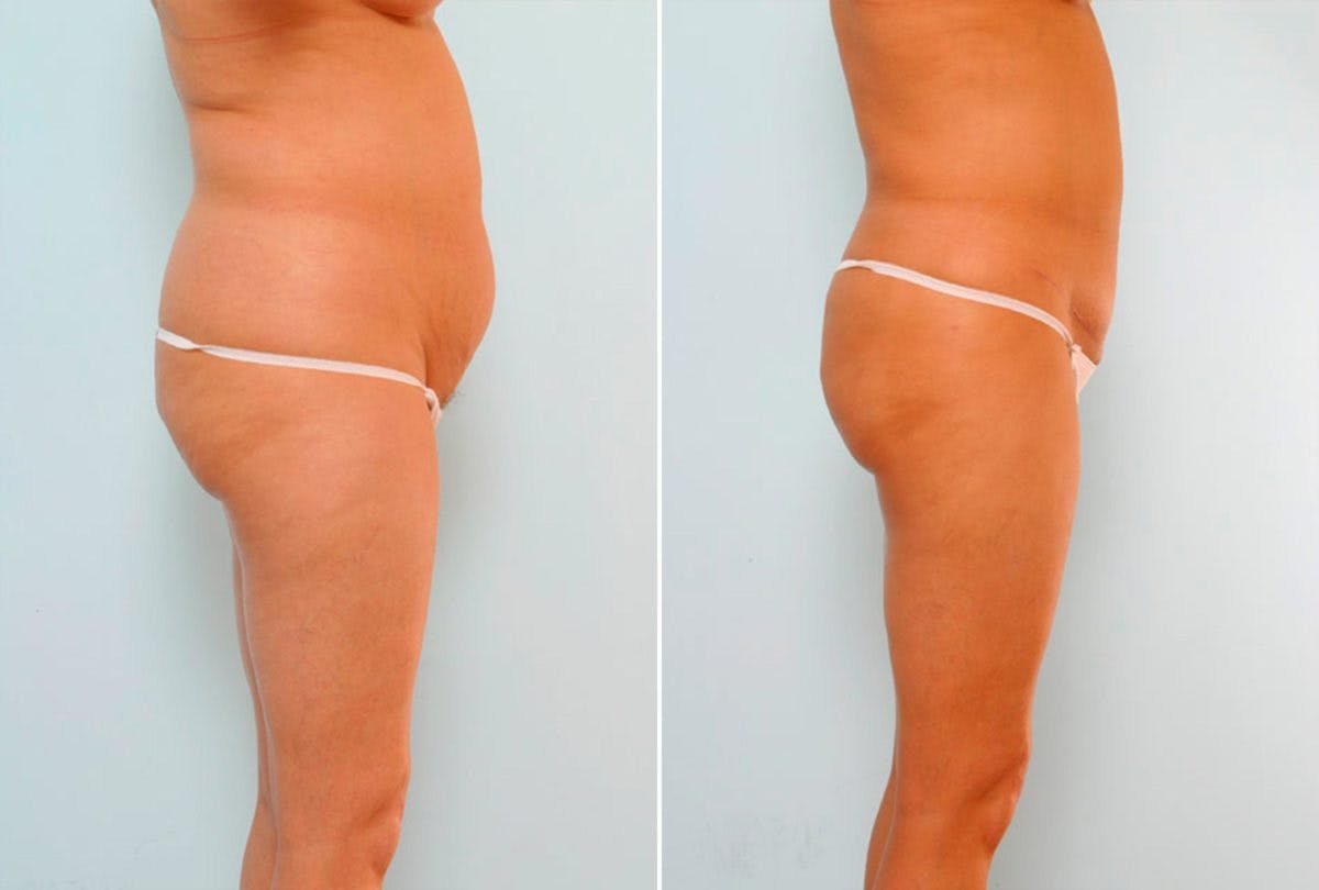 Abdominoplasty Before & After Gallery - Patient 54871959 - Image 3