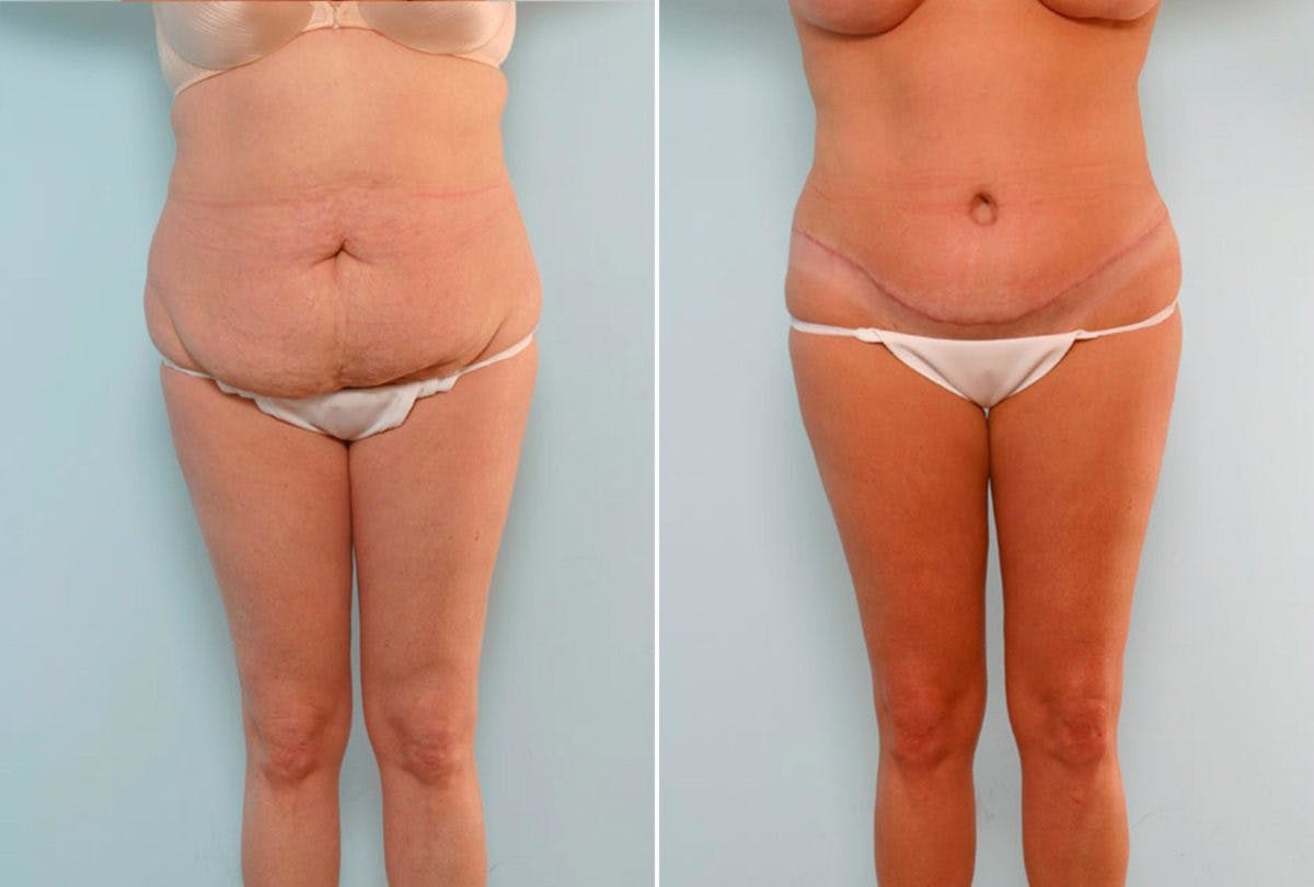 Abdominoplasty Before & After Gallery - Patient 54876180 - Image 1