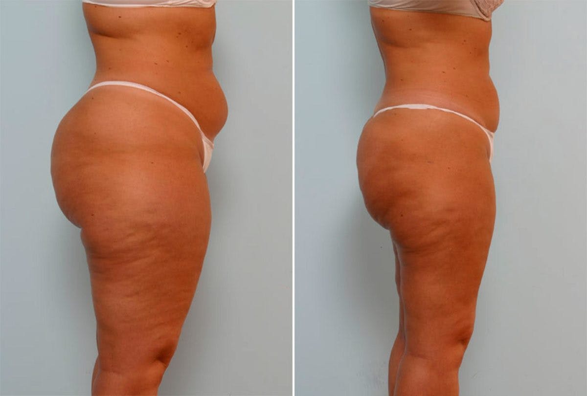 Female Liposuction Before & After Gallery - Patient 54871961 - Image 2