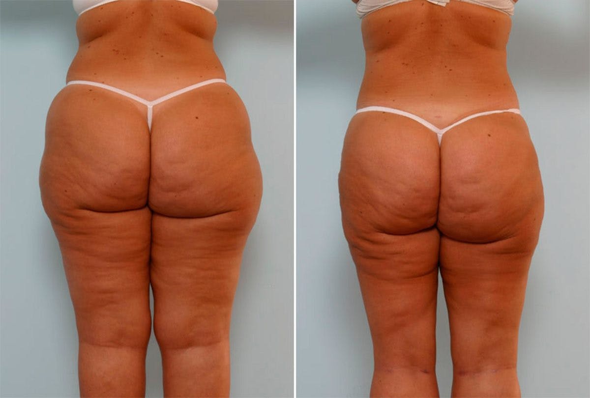 Female Liposuction Before & After Gallery - Patient 54871961 - Image 3