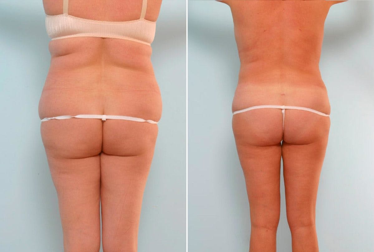 Abdominoplasty Before & After Gallery - Patient 54876180 - Image 4