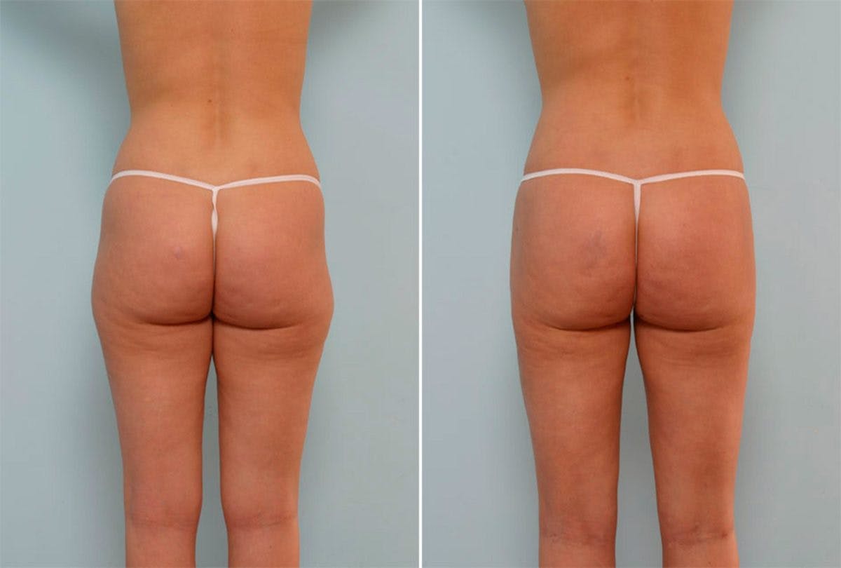 Female Liposuction Before & After Gallery - Patient 54876181 - Image 3