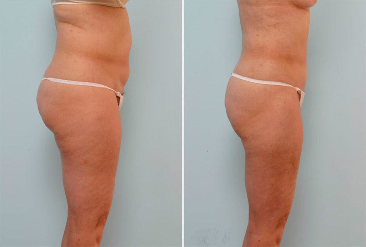 Female Liposuction Before & After Gallery - Patient 54876183 - Image 2
