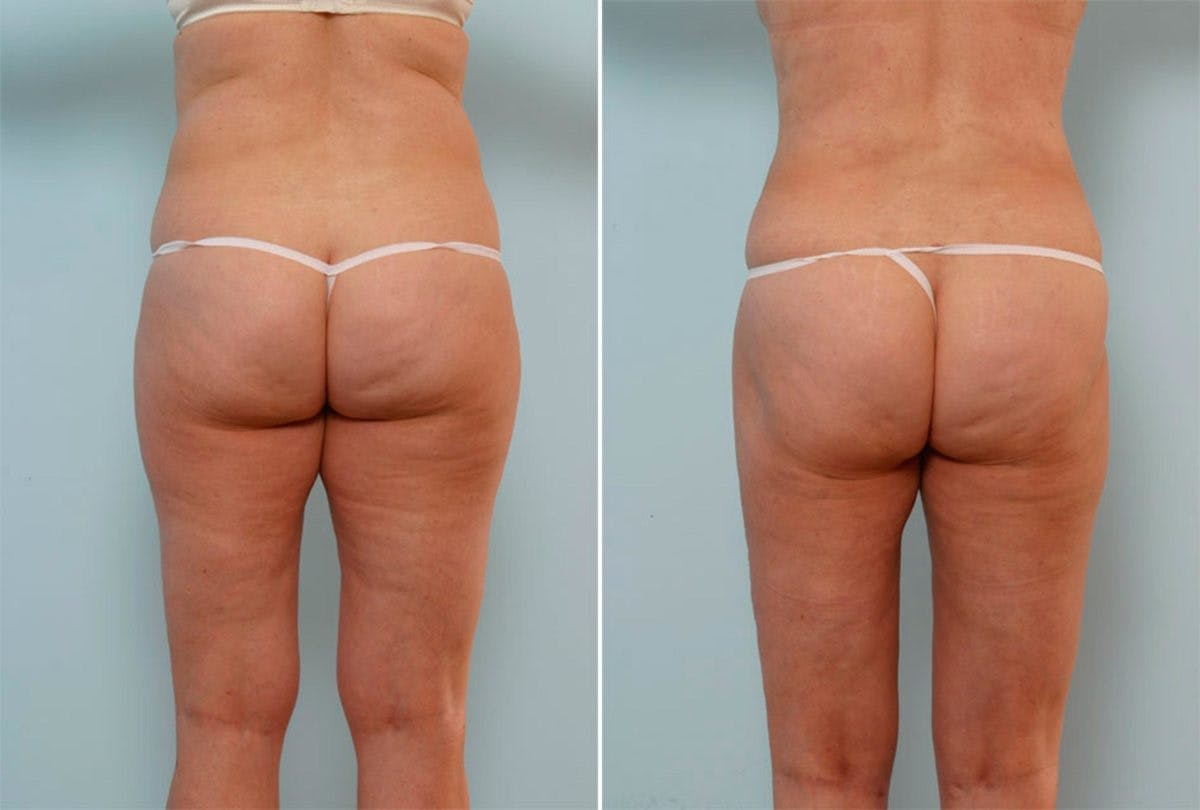 Female Liposuction Before & After Gallery - Patient 54876183 - Image 3