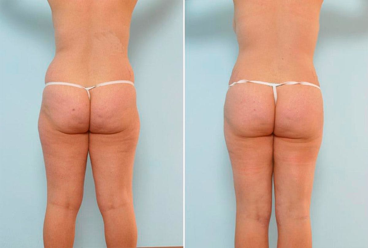 Abdominoplasty Before & After Gallery - Patient 54876184 - Image 4