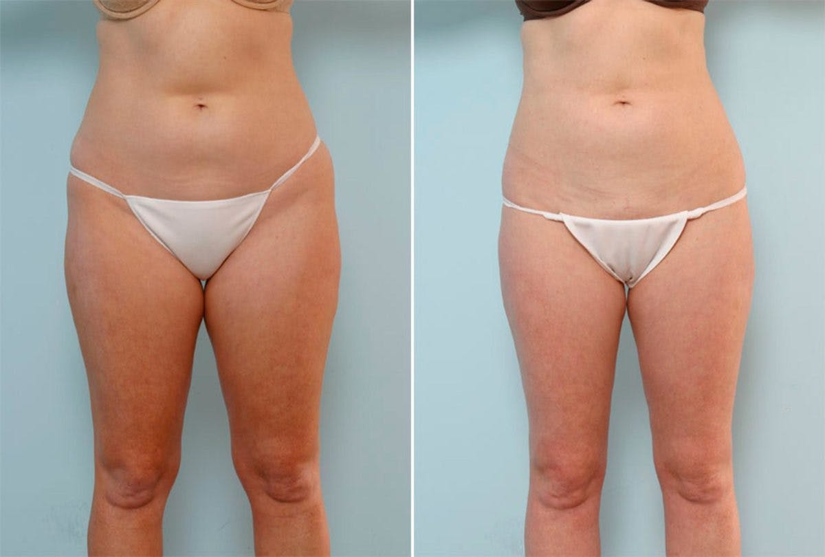 Female Liposuction Before & After Gallery - Patient 54876186 - Image 1