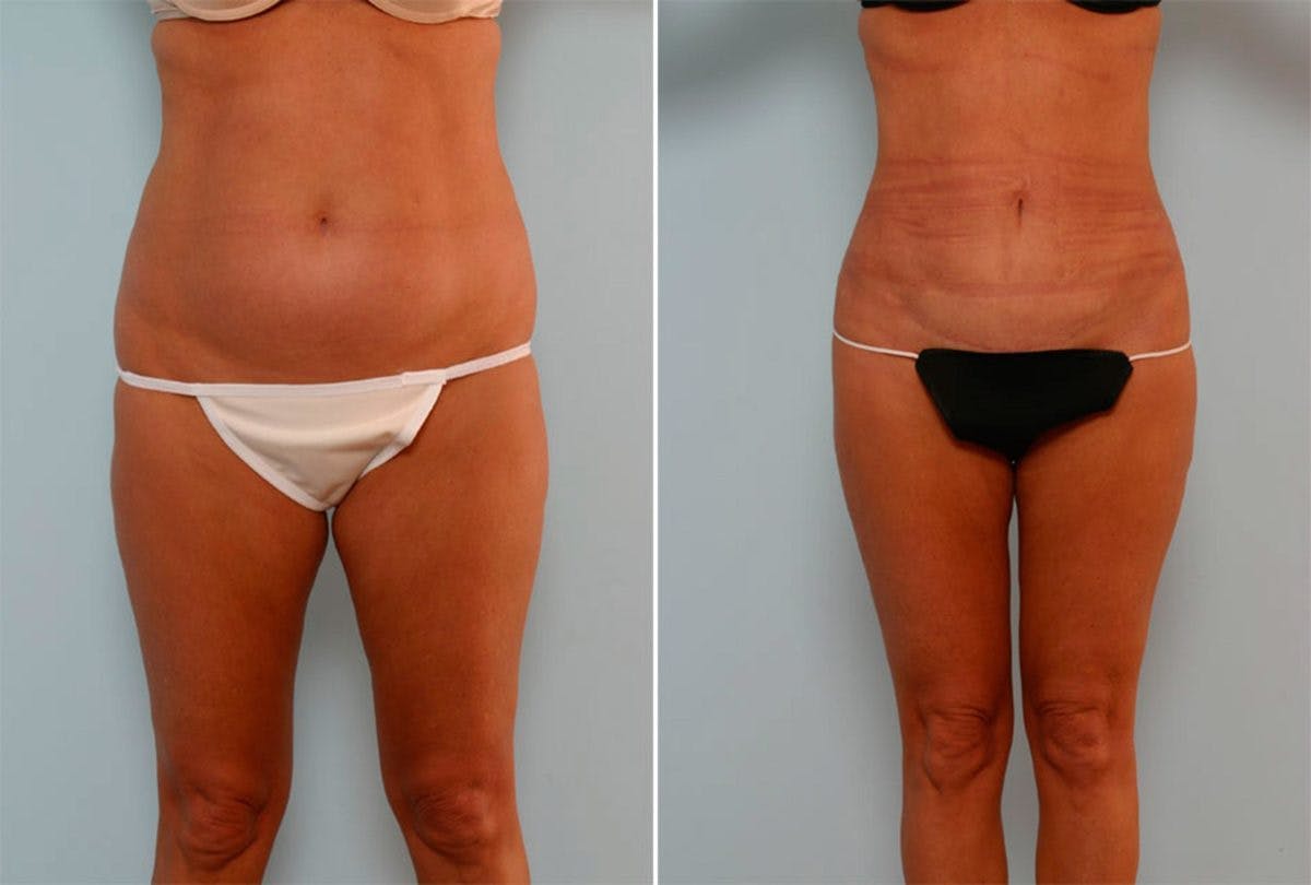 Female Liposuction Before & After Photo - Patient 54876190 - Image 1