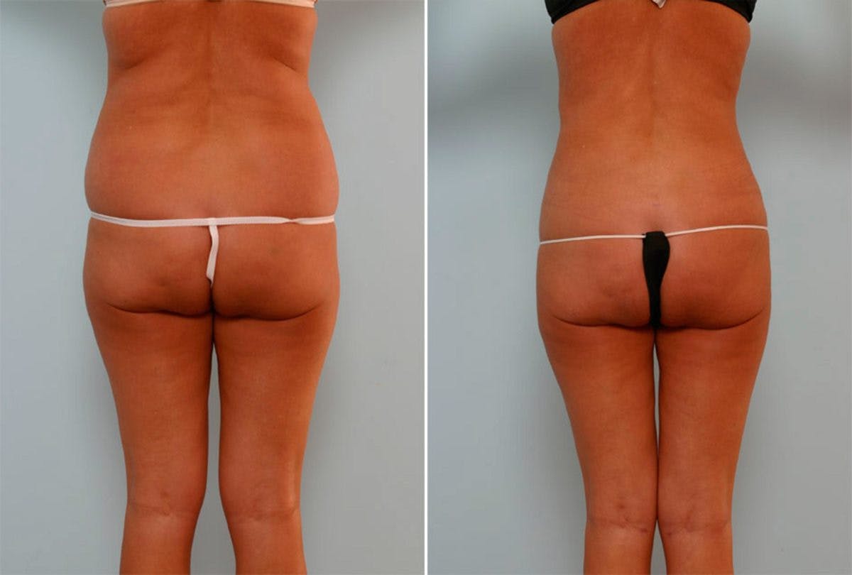 Female Liposuction Before & After Photo - Patient 54876190 - Image 3