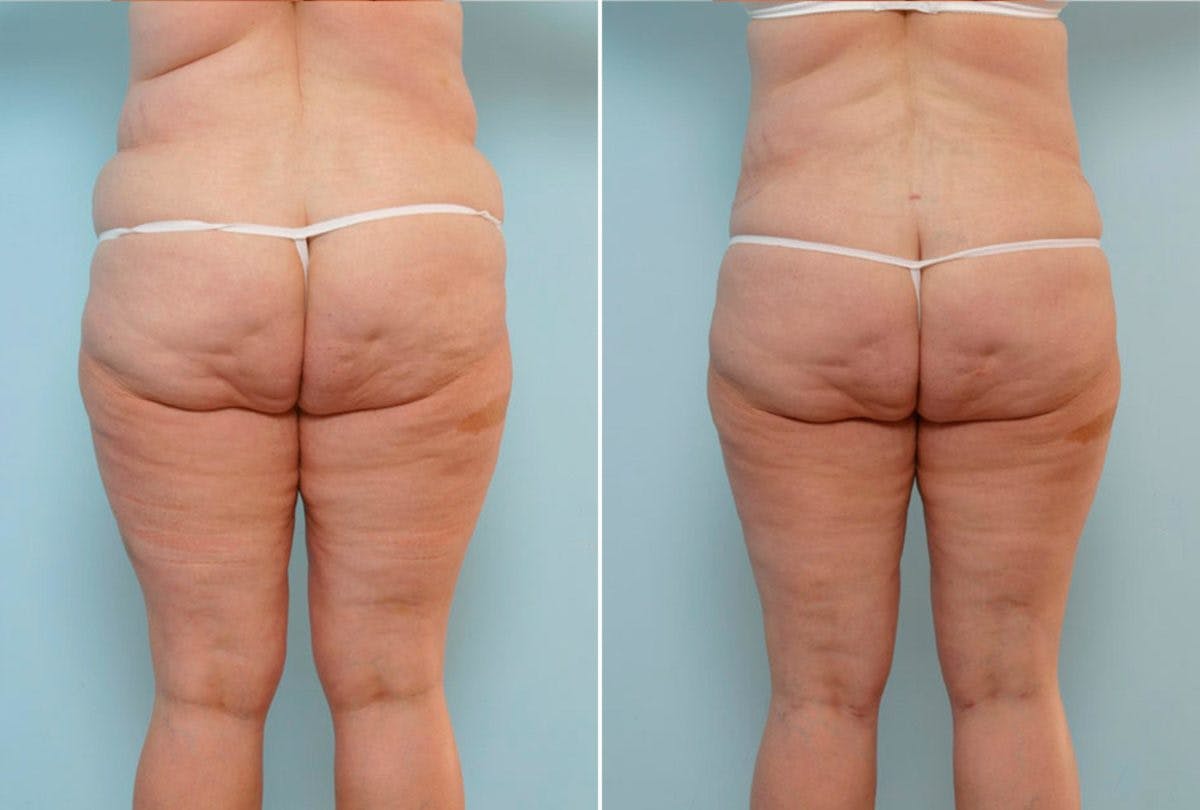 Abdominoplasty Before & After Gallery - Patient 54876192 - Image 4