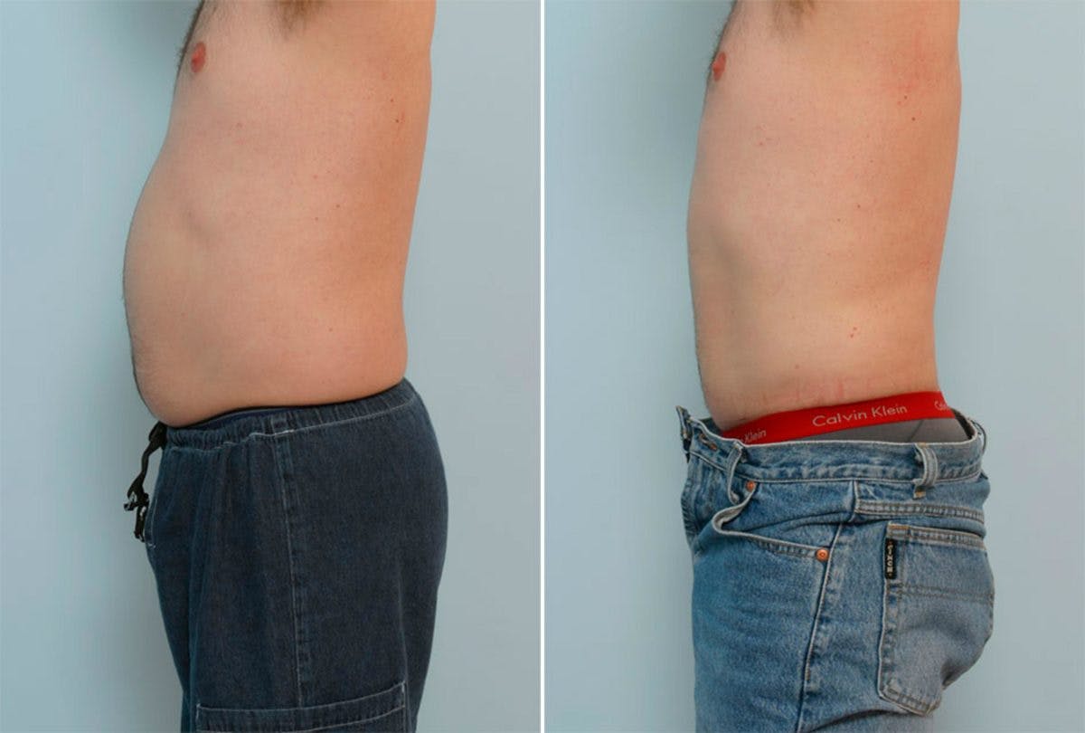 Male Liposuction Before & After Gallery - Patient 55485566 - Image 2