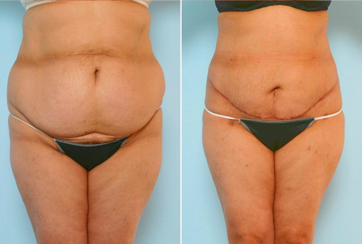 Abdominoplasty Before & After Gallery - Patient 54876197 - Image 1