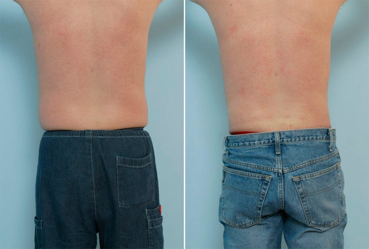 Male Liposuction Before & After Gallery - Patient 55485566 - Image 3
