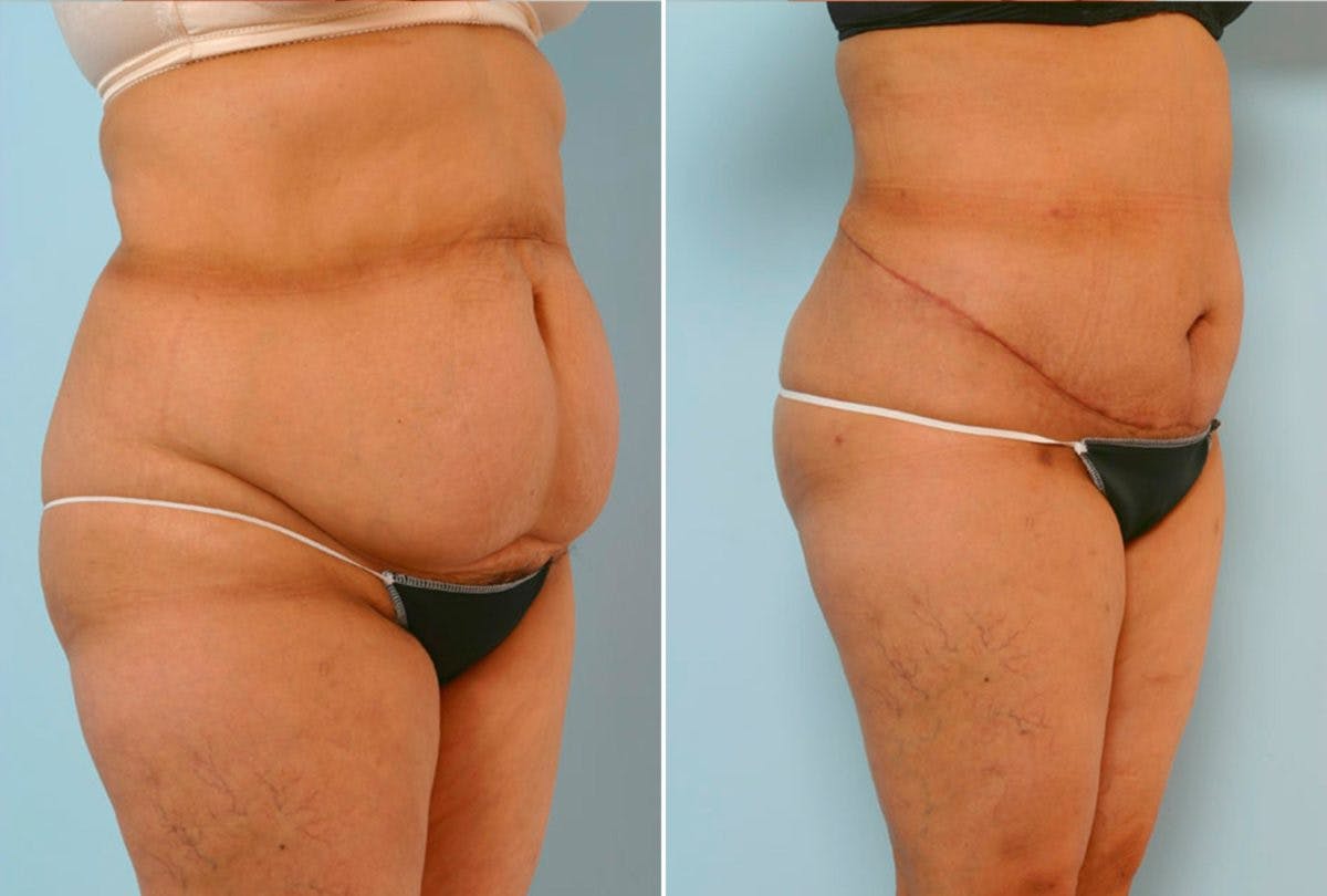 Abdominoplasty Before & After Gallery - Patient 54876197 - Image 2