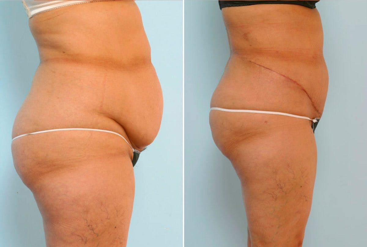 Abdominoplasty Before & After Gallery - Patient 54876197 - Image 3