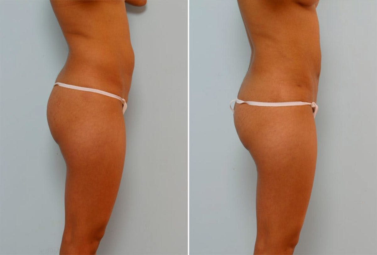 Female Liposuction Before & After Photo - Patient 54876198 - Image 2