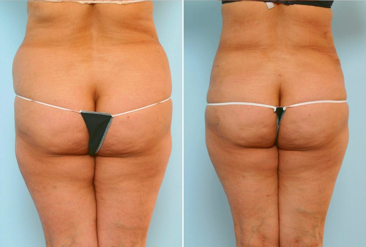Abdominoplasty Before & After Gallery - Patient 54876197 - Image 4
