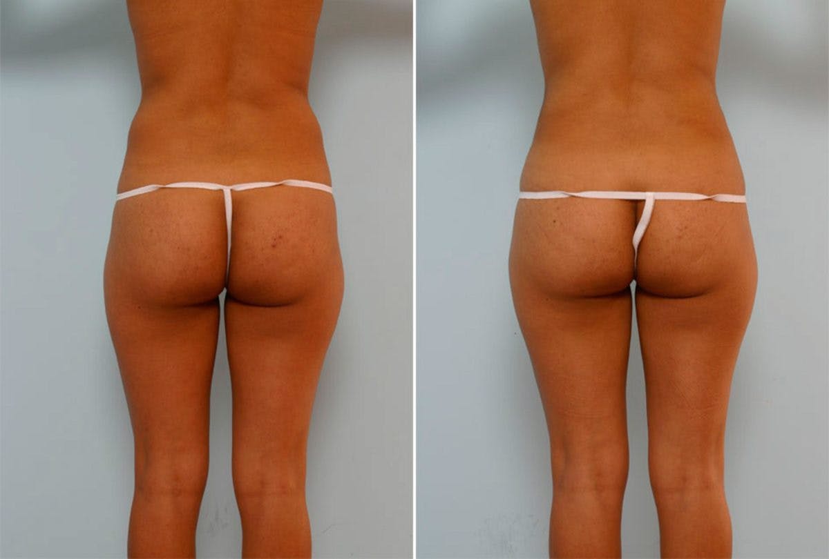 Female Liposuction Before & After Photo - Patient 54876198 - Image 3