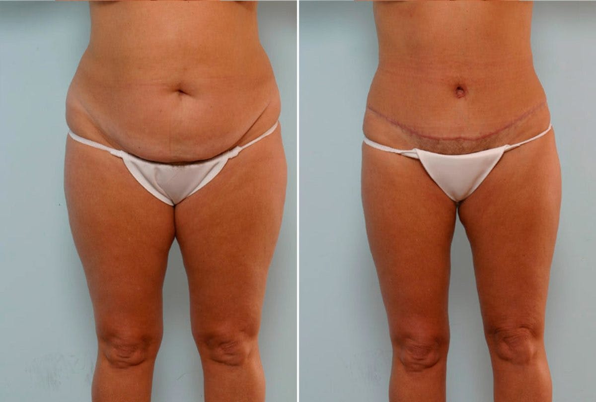 Abdominoplasty Before & After Gallery - Patient 54876200 - Image 1