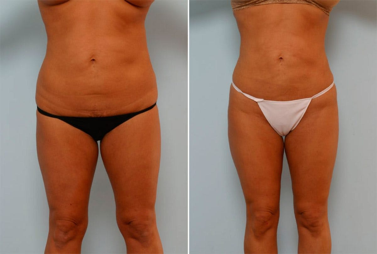 Female Liposuction Before & After Gallery - Patient 54876201 - Image 1