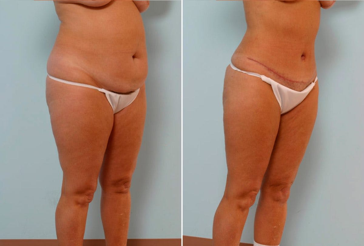 Abdominoplasty Before & After Gallery - Patient 54876200 - Image 2