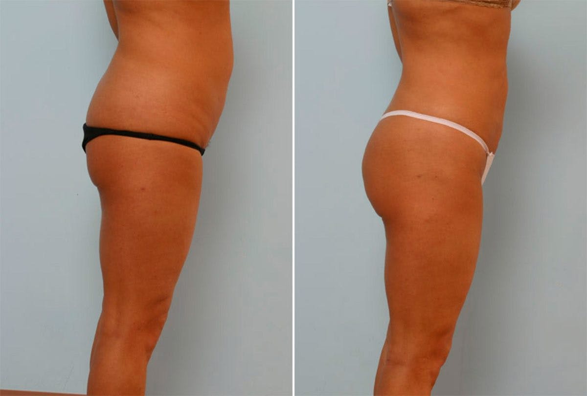 Female Liposuction Before & After Gallery - Patient 54876201 - Image 2