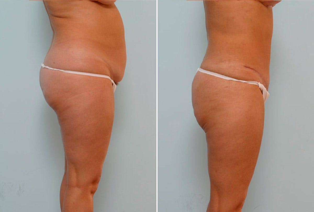 Abdominoplasty Before & After Gallery - Patient 54876200 - Image 3