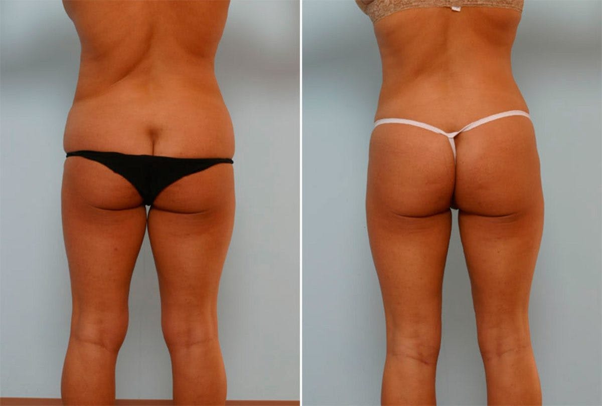 Female Liposuction Before & After Gallery - Patient 54876201 - Image 3