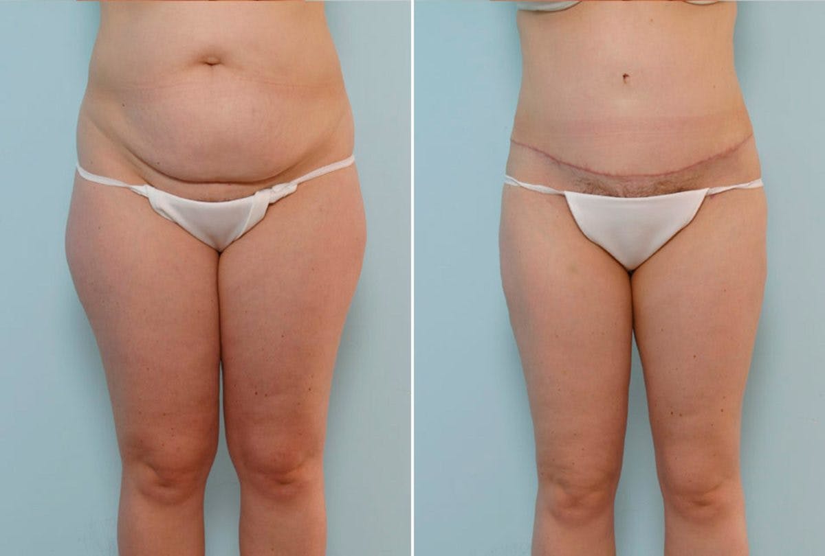 Abdominoplasty Before & After Gallery - Patient 54876206 - Image 1