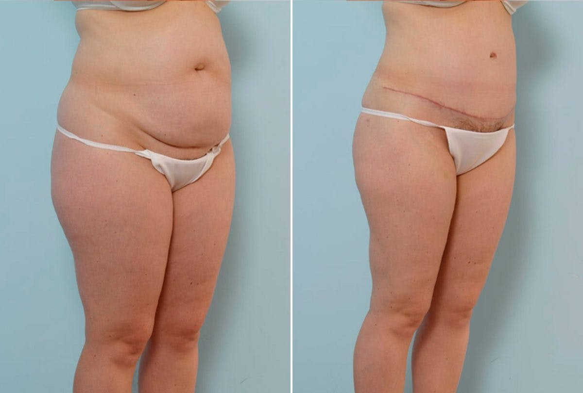 Abdominoplasty Before & After Gallery - Patient 54876206 - Image 2