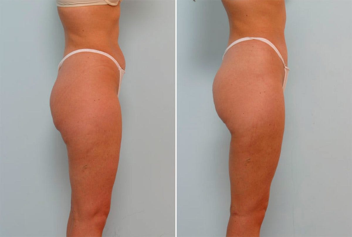 Female Liposuction Before & After Gallery - Patient 54876202 - Image 2