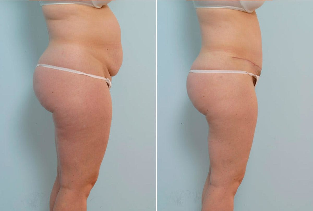 Abdominoplasty Before & After Gallery - Patient 54876206 - Image 3