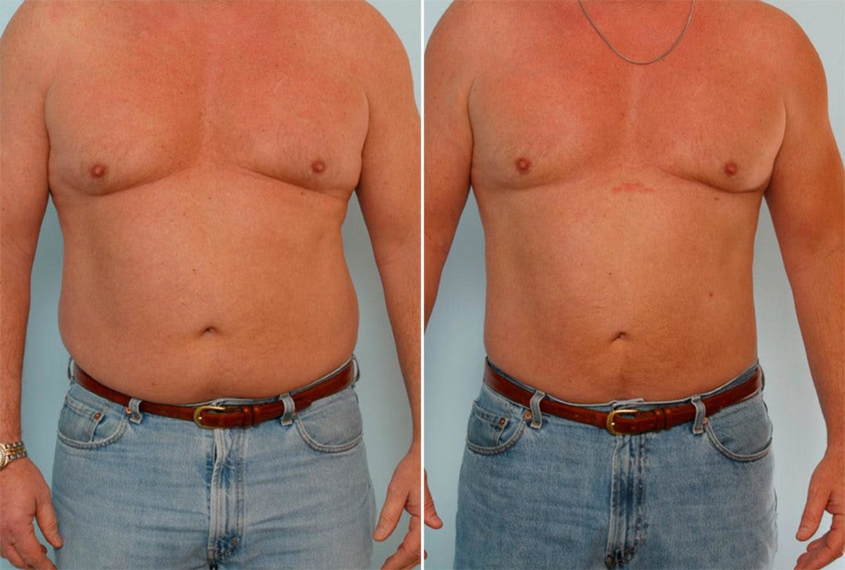 Male Liposuction Before & After Gallery - Patient 55485570 - Image 1