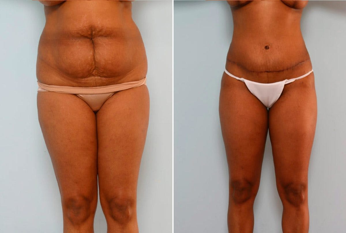 Abdominoplasty Before & After Gallery - Patient 54876209 - Image 1