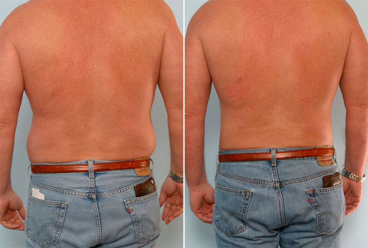 Male Liposuction Before & After Gallery - Patient 55485570 - Image 3