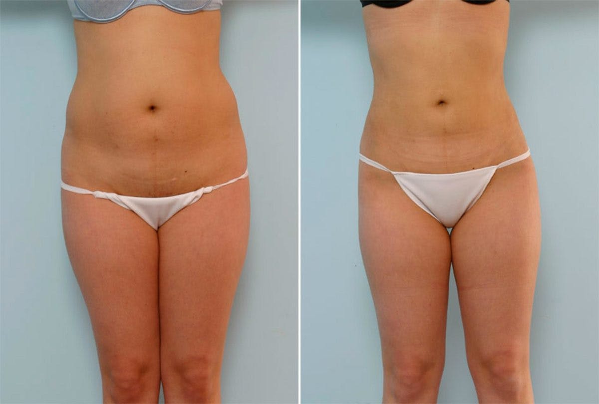 Female Liposuction Before & After Gallery - Patient 54876210 - Image 1