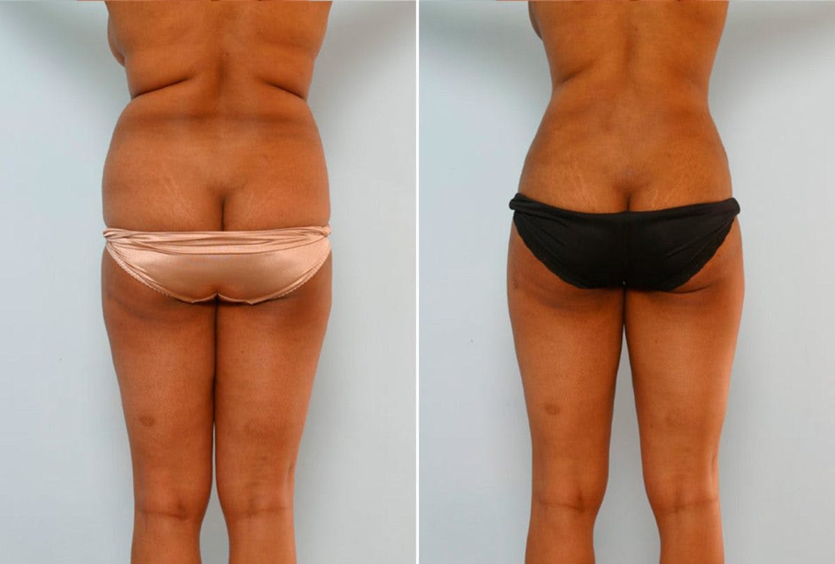 Abdominoplasty Before & After Gallery - Patient 54876209 - Image 4