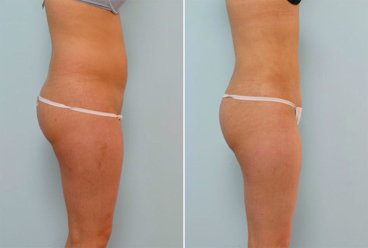 Female Liposuction Before & After Photo - Patient 54876210 - Image 2