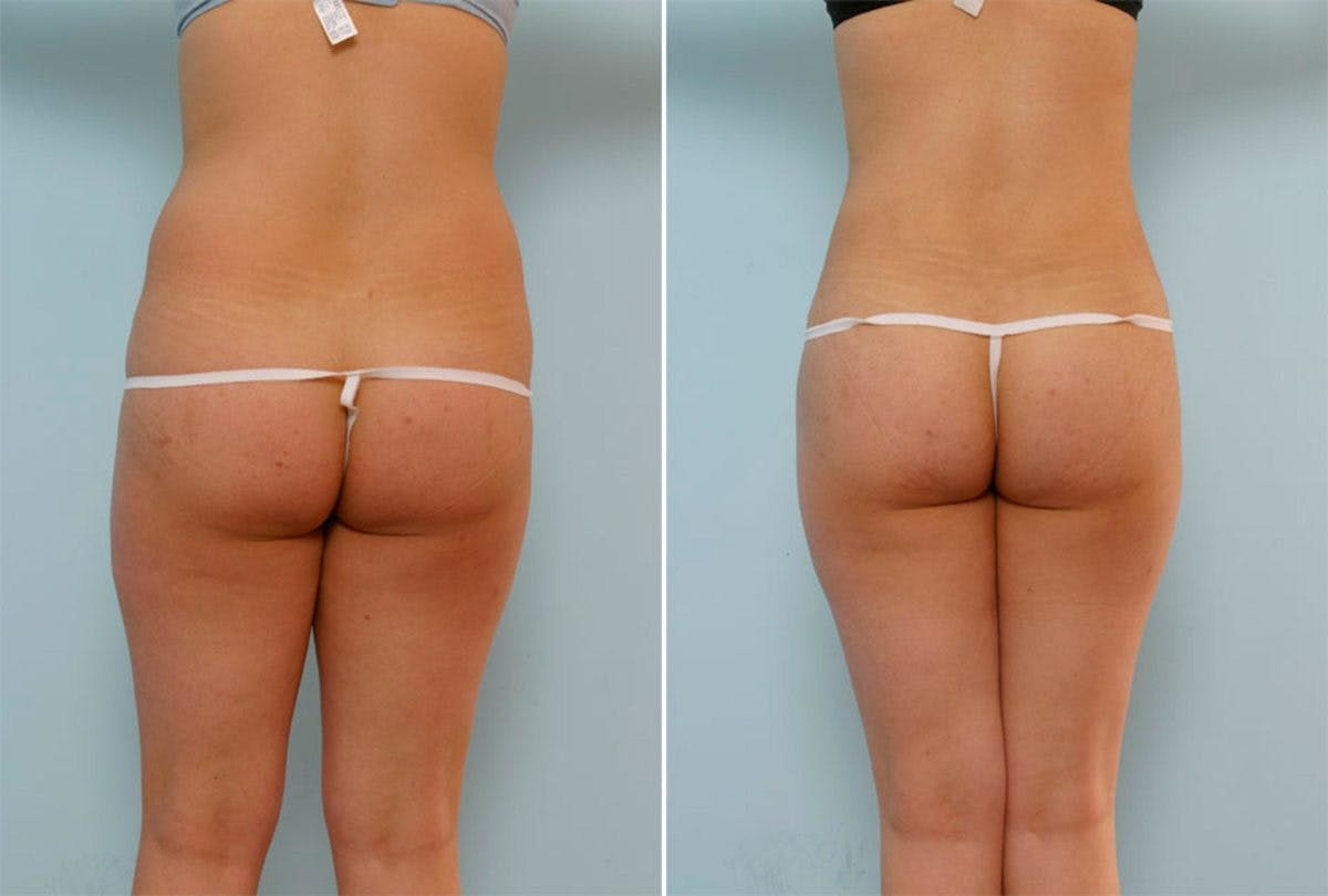 Female Liposuction Before & After Gallery - Patient 54876210 - Image 3