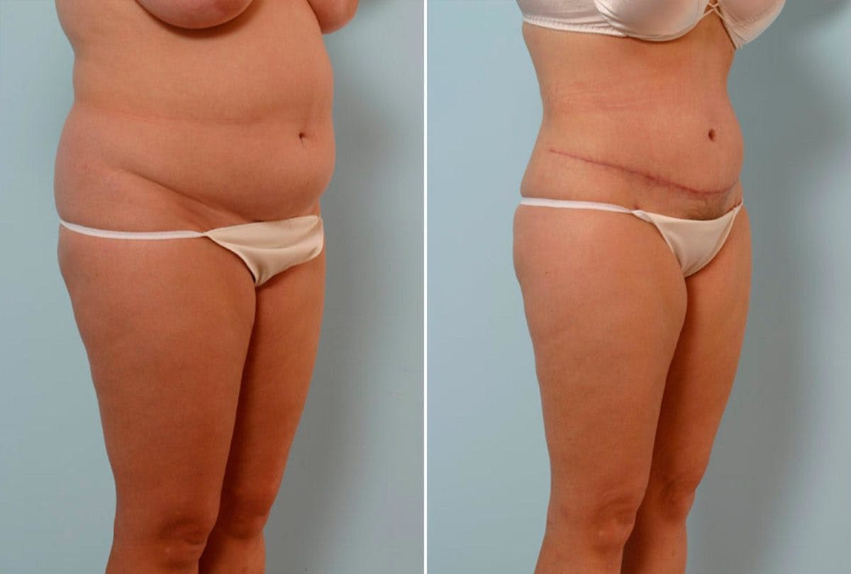 Abdominoplasty Before & After Gallery - Patient 54876212 - Image 2