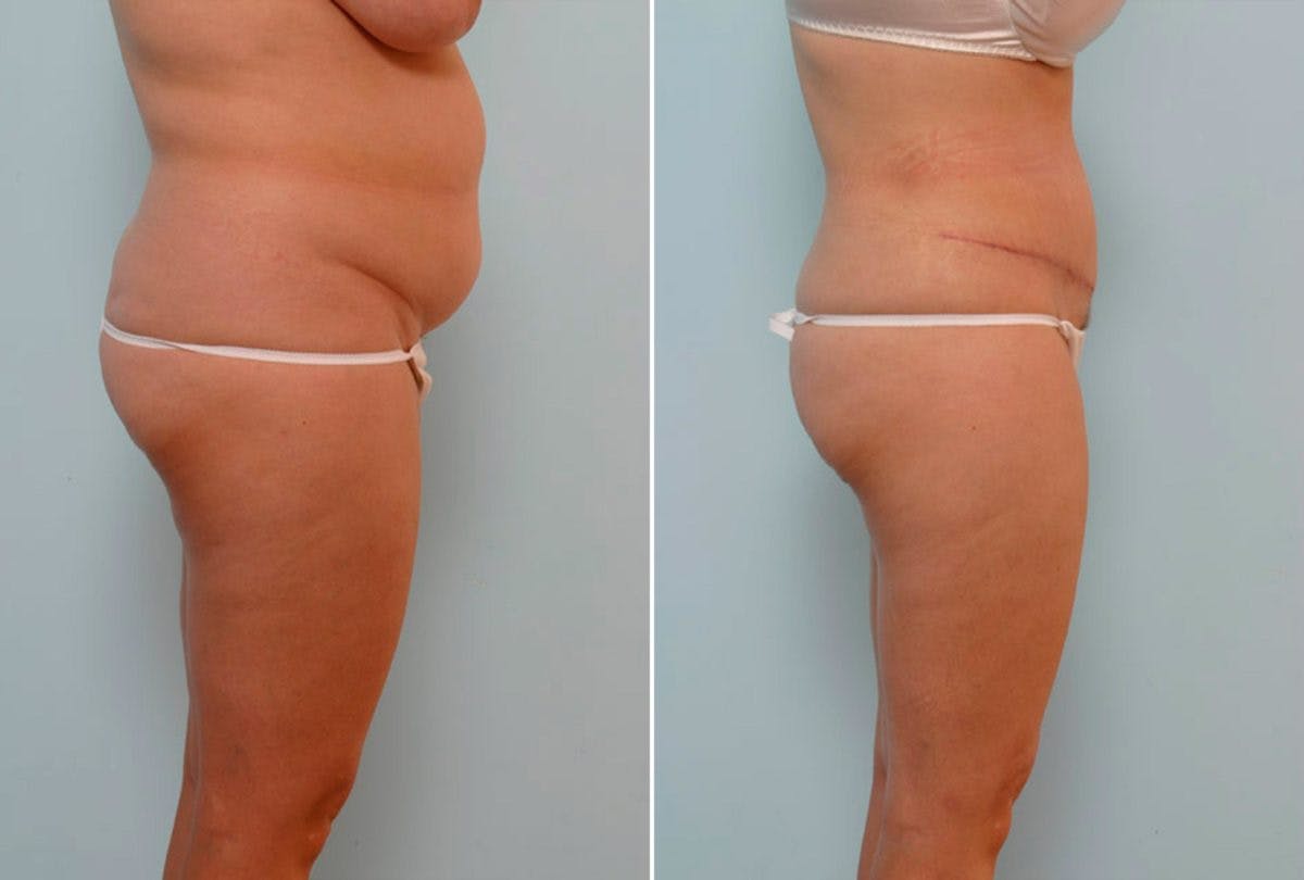 Abdominoplasty Before & After Gallery - Patient 54876212 - Image 3