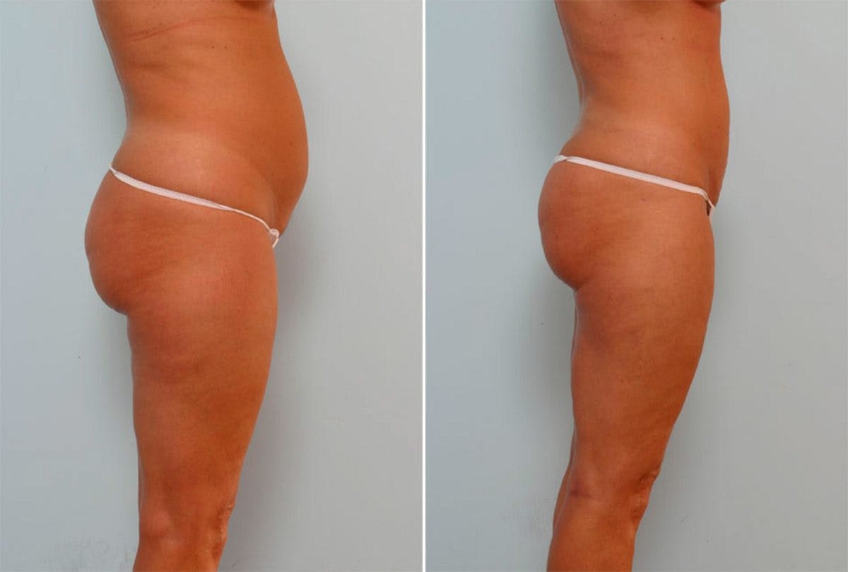 Female Liposuction Before & After Gallery - Patient 54876213 - Image 2