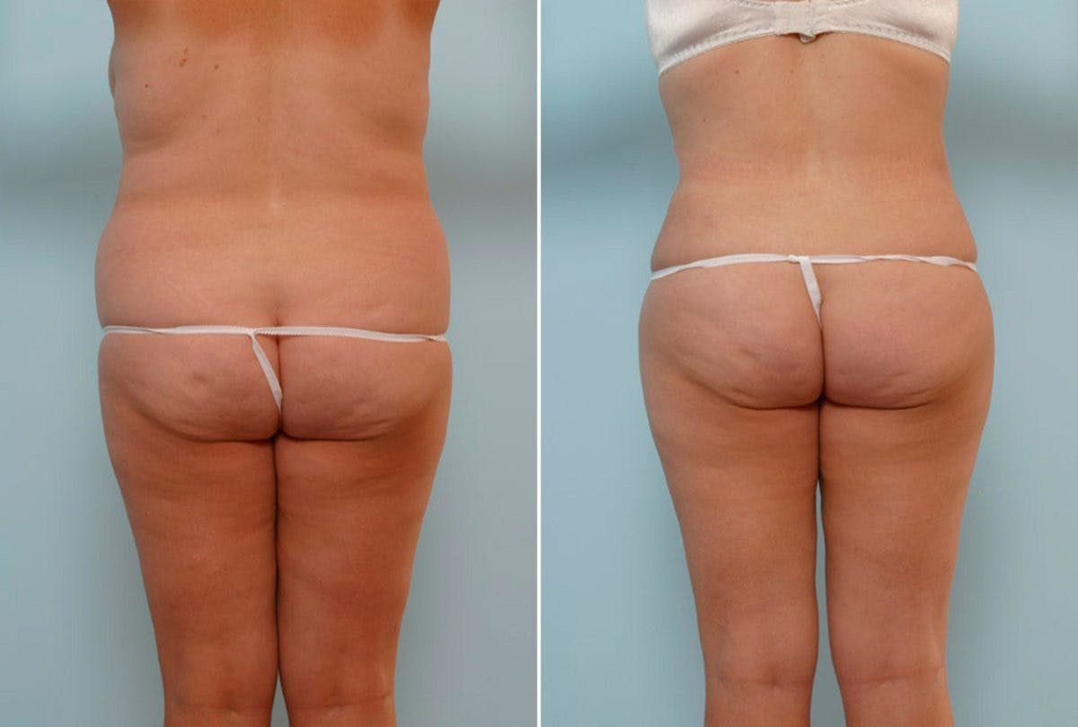 Abdominoplasty Before & After Gallery - Patient 54876212 - Image 4