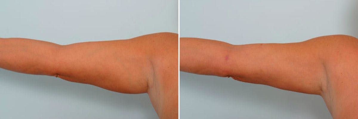 Female Liposuction Before & After Gallery - Patient 54876213 - Image 4